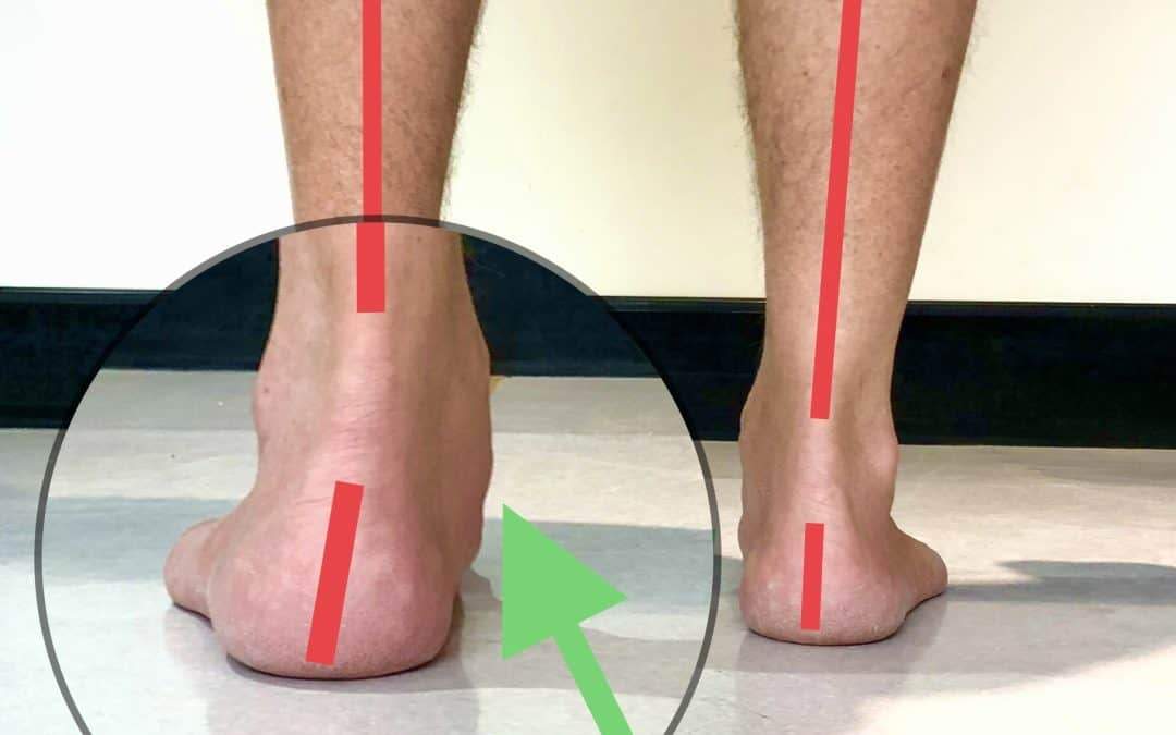 Fallen Arches or Flat Feet and what you need to know | A Step Ahead ...