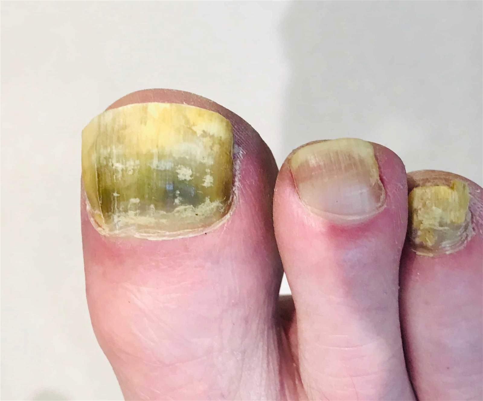 8. Foot Nail Color Changes and Fungal Infections - wide 3