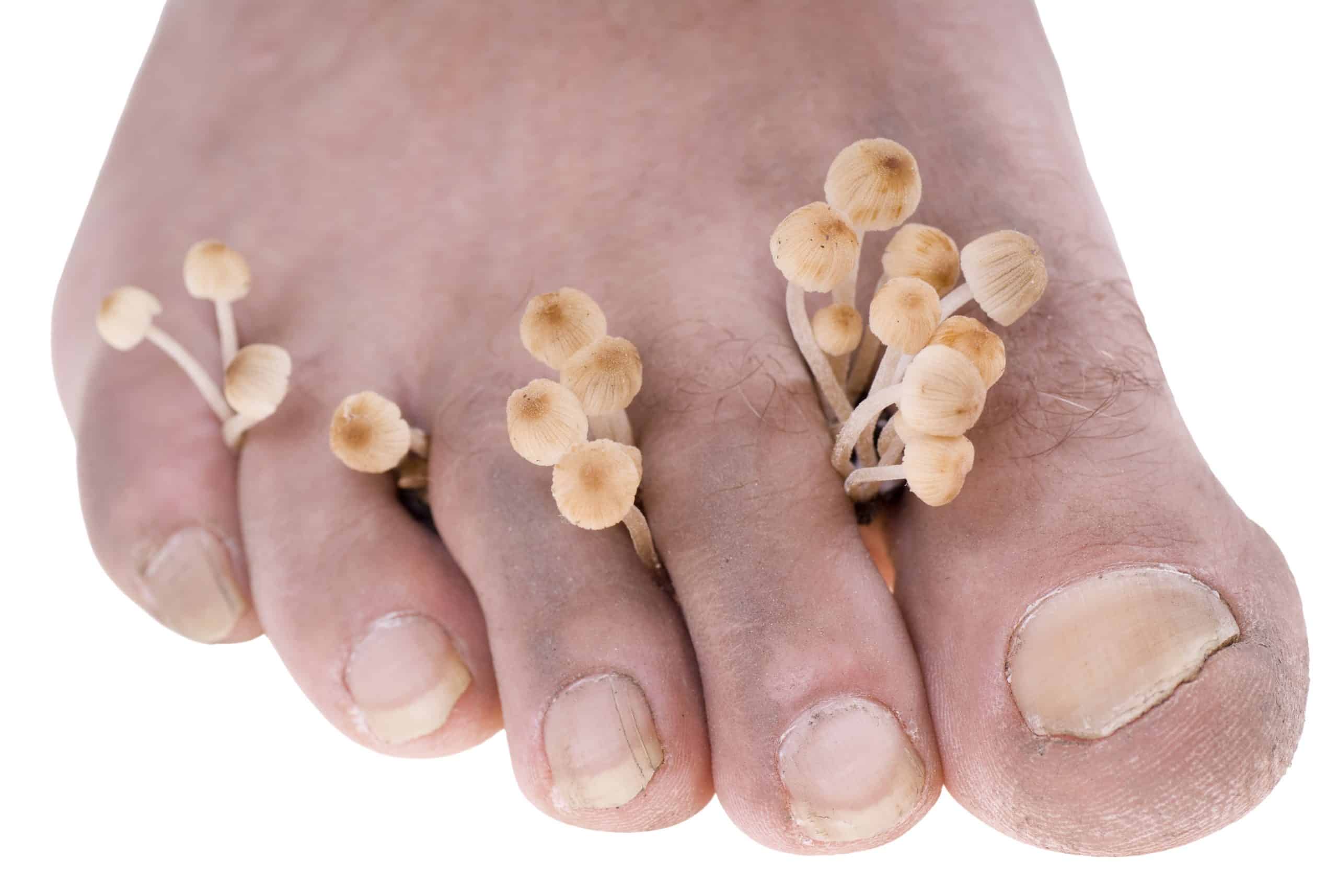 Fungal Nail Infections - 5 questions to ask Fungal Nail Infections - 5 questions to ask