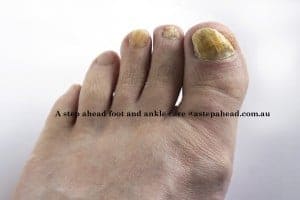 How Tanya beat unsightly Nail Fungus - 2