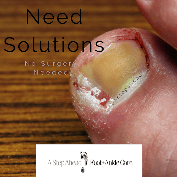 Ingrown Toenails – Need Solutions?