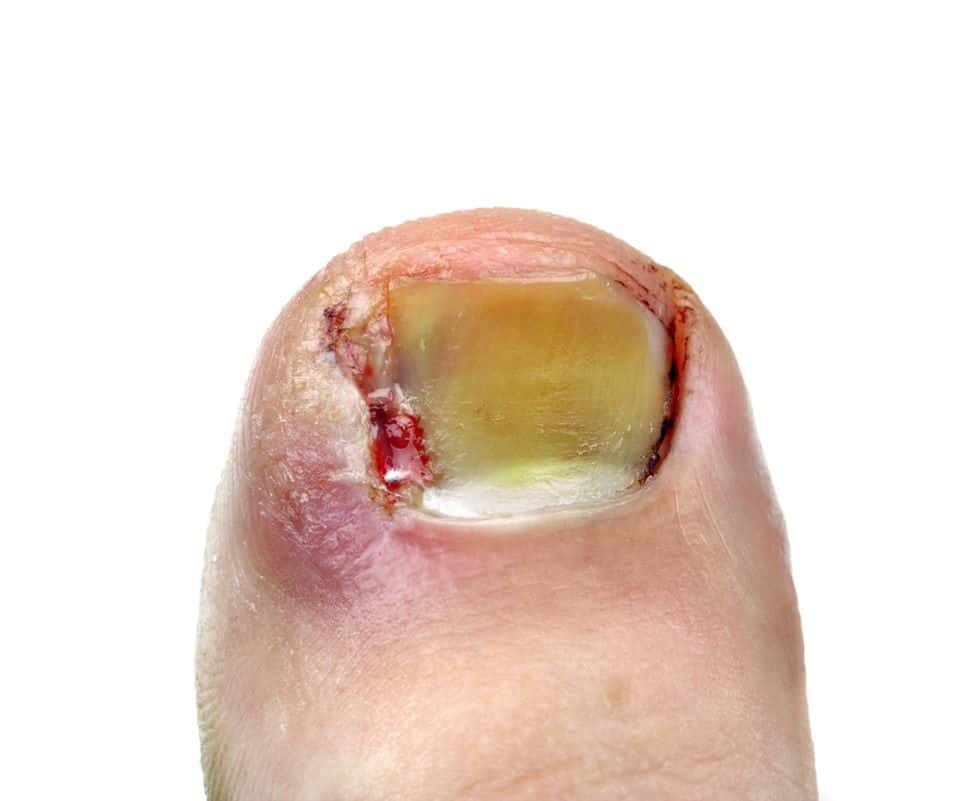 Ingrown toenails Ouchi Mumma these can hurt Ingrown toenails Ouchi Mumma these can hurt