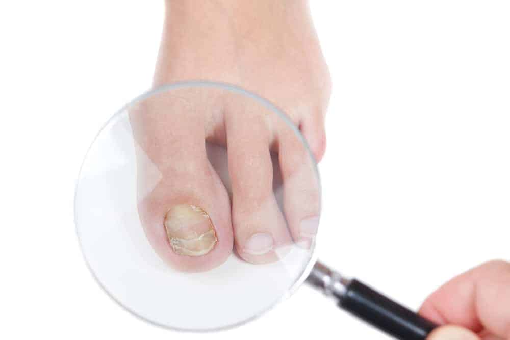 Nailing fungus with laser technology - 1