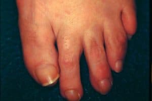 The GAP between my toes has a name; Plantar plate disruption - 1